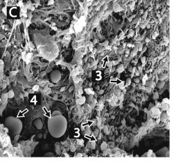 Scanning electron micrograph of an arterial thrombus: dense platelet aggregates and fibrin, with balloon shaped red cells trapped in the mesh