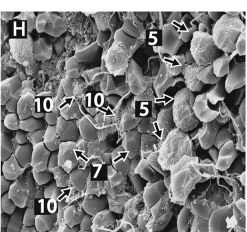 Scanning electron micrograph of a pulmonary embolus: compressed red cells, scattered white blood cells and microvesicles