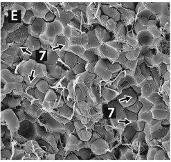 Scanning electron micrograph of a venous thrombus: a tight pavement of polyhedral red blood cells with almost no platelets