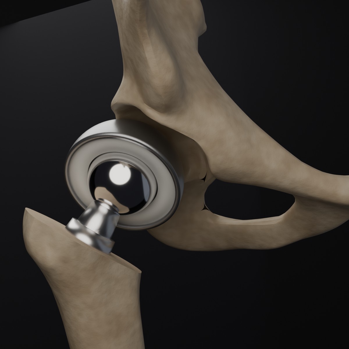3D render of a total hip replacement: a polished metal ball on a stem seated in the femur, with a metal cup in the pelvic socket, built from BodyParts3D anatomical models