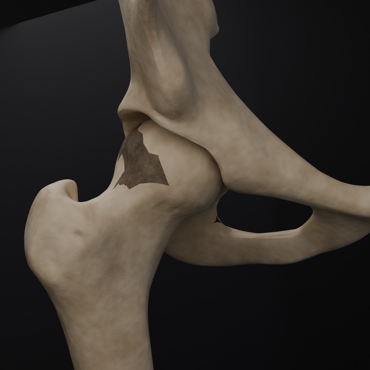 3D render of a hip joint with osteonecrosis: a darkened segment in the weight bearing dome of the femoral head, built from BodyParts3D anatomical models