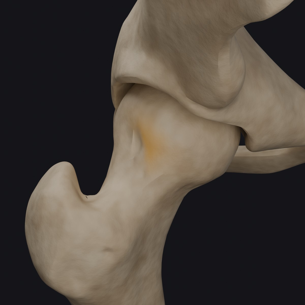 3D render of a hip joint with a shallow socket: the femoral head sits partly uncovered by the pelvic cup, built from BodyParts3D anatomical models
