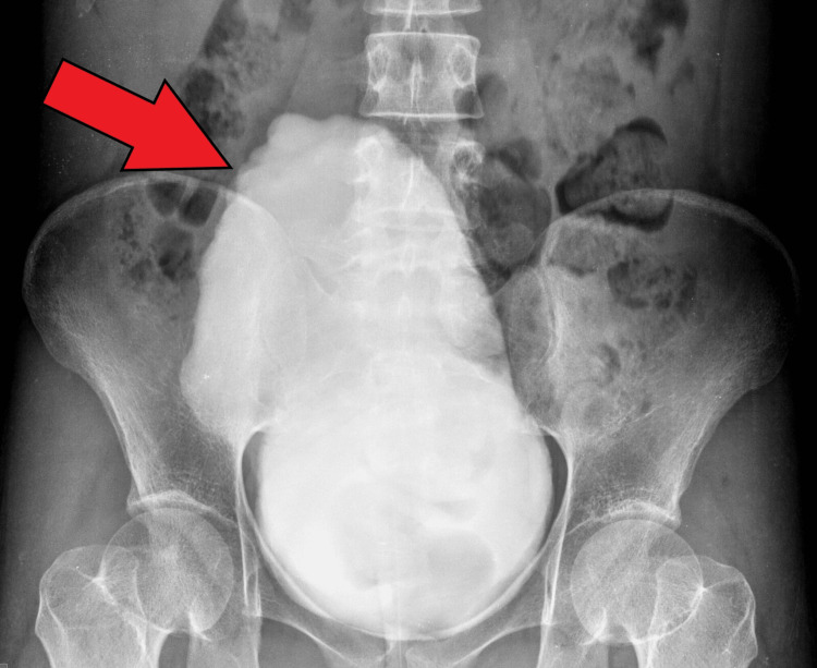 Micturating cystourethrogram showing a Christmas tree shaped neurogenic bladder