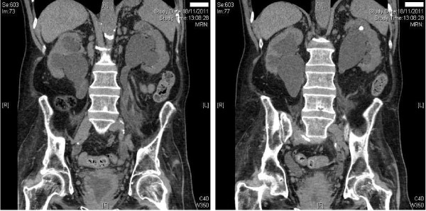 Coronal CT showing bilateral hydronephrosis and hydroureter