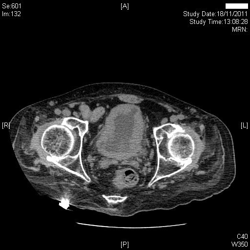 CT showing a thickened, trabeculated, contracted bladder