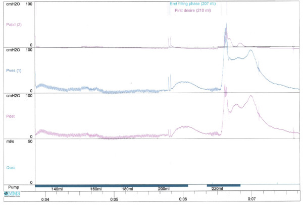 Real urodynamics tracing showing detrusor pressure rising to 100 cm H2O