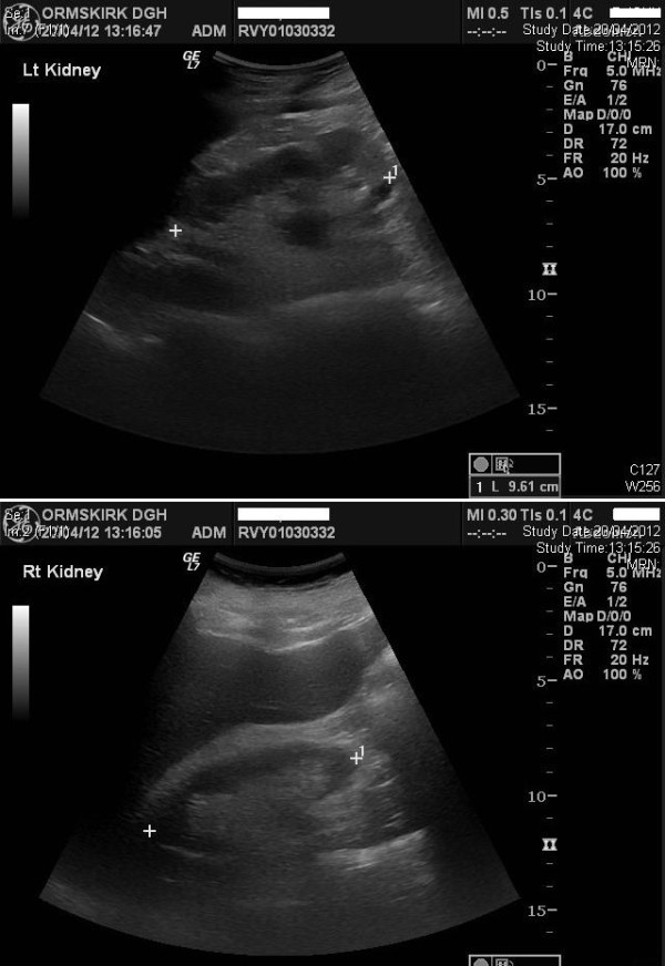 Renal ultrasounds after drainage showing normal kidneys without hydronephrosis